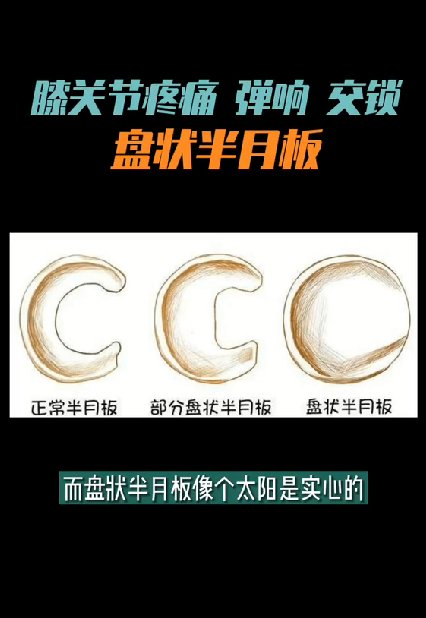 盘状半月板