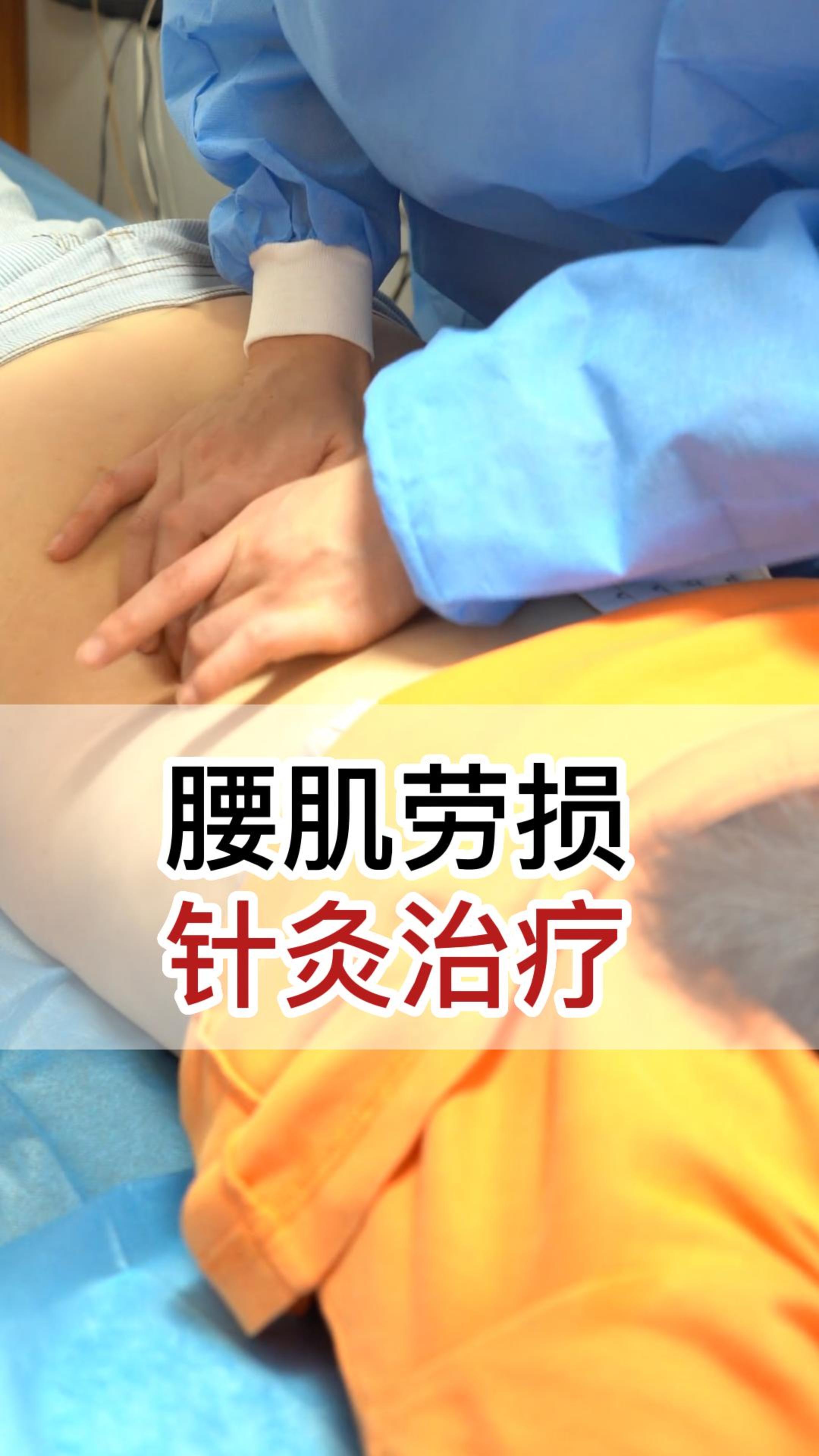 腰肌劳损针灸治疗