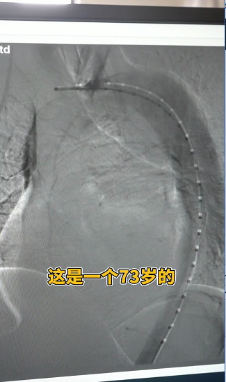 一个73岁主动脉夹层变形的病人